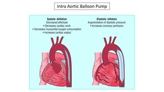 Intra Aortic Balloon Pump
 