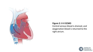 V-V ECMO
Support for severe pulmonary failure (w/o cardiac failure).
Clinical Condition Appropriate For V-V ECMO
• Pneumon...