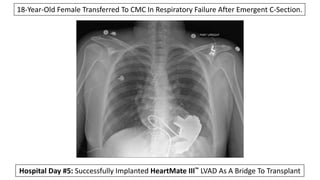 Chest X-Ray Following Orthotopic Heart Transplant 6 Months Later
49-Year-Old
Male With Non-
Ischemic
Cardiomyopathy.
 