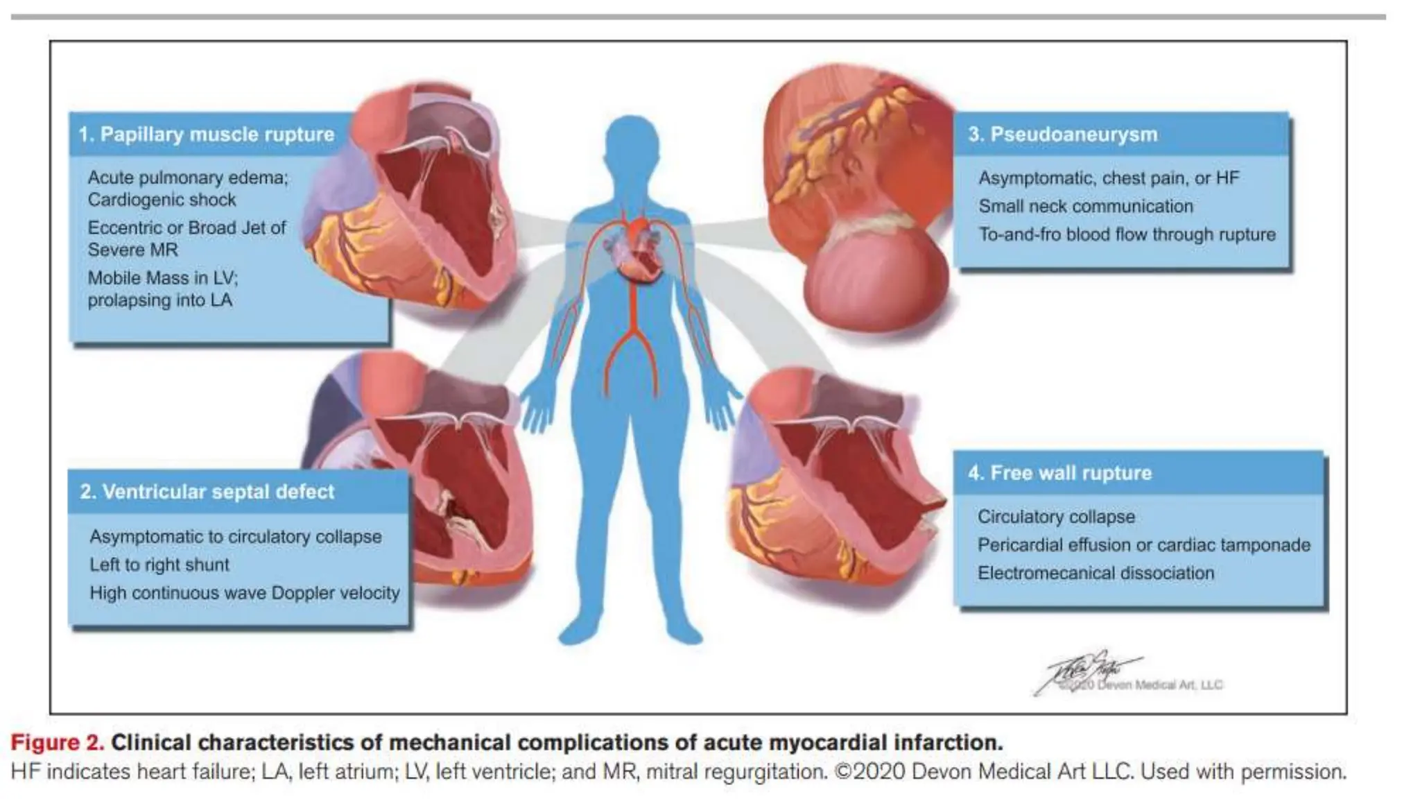 Mechanical Complications of Acute Myocardial Infraction-1.pptx
