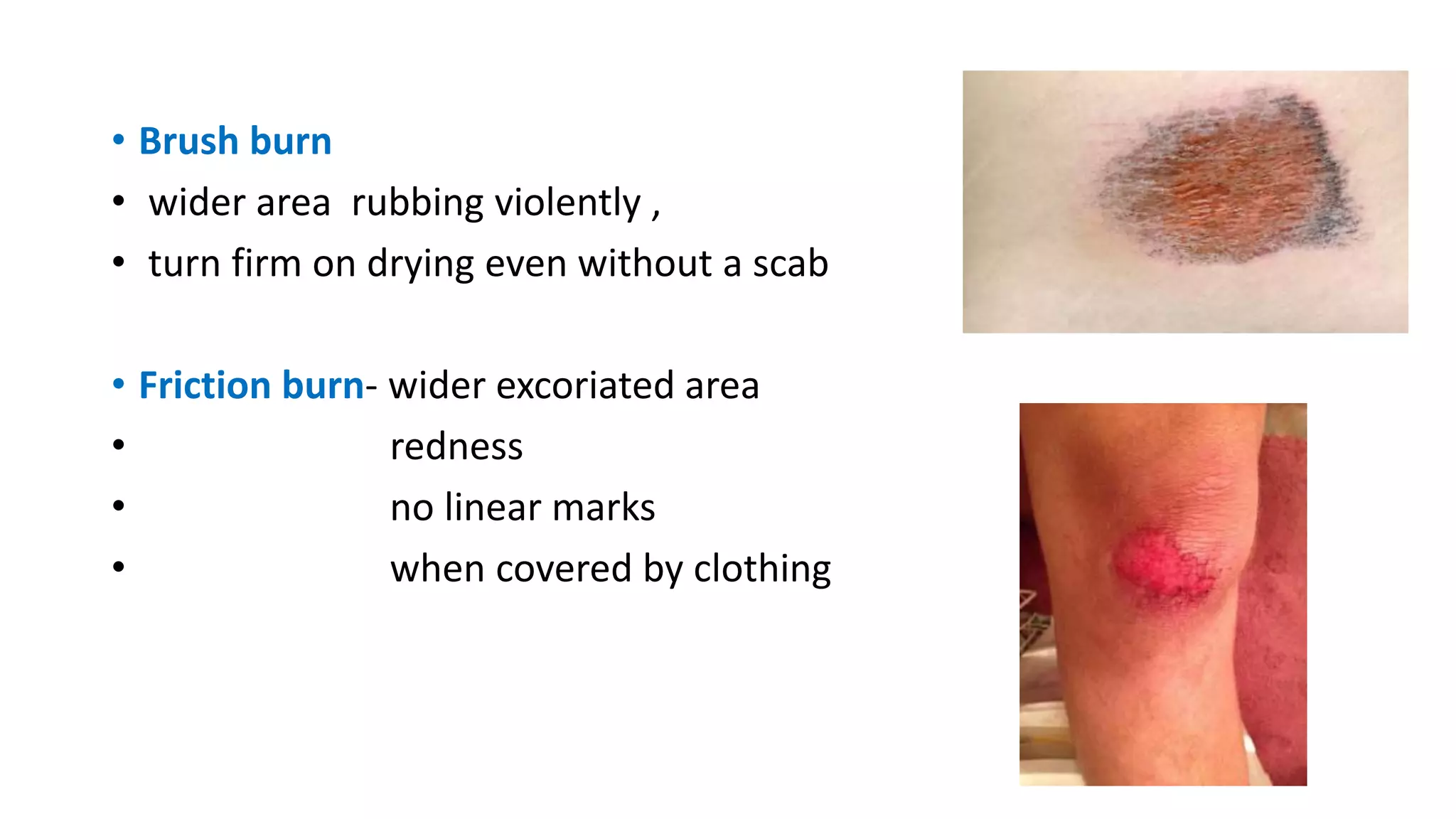 • Brush burn
• wider area rubbing violently ,
• turn firm on drying even without a scab
• Friction burn- wider excoriated area
• redness
• no linear marks
• when covered by clothing
 