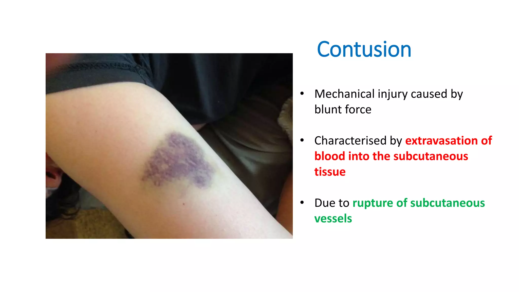 Contusion
• Mechanical injury caused by
blunt force
• Characterised by extravasation of
blood into the subcutaneous
tissue
• Due to rupture of subcutaneous
vessels
 