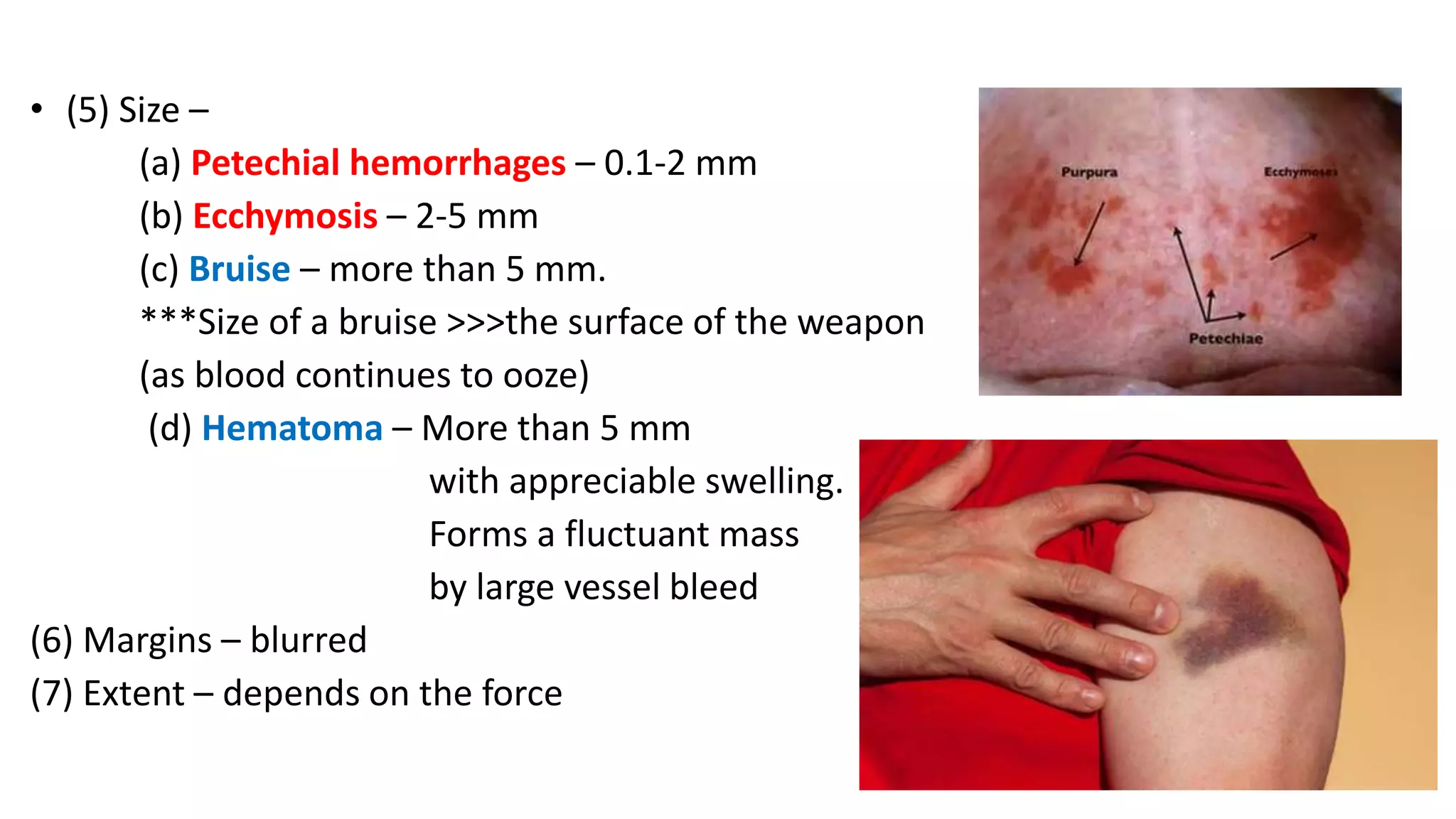• (5) Size –
(a) Petechial hemorrhages – 0.1-2 mm
(b) Ecchymosis – 2-5 mm
(c) Bruise – more than 5 mm.
***Size of a bruise >>>the surface of the weapon
(as blood continues to ooze)
(d) Hematoma – More than 5 mm
with appreciable swelling.
Forms a fluctuant mass
by large vessel bleed
(6) Margins – blurred
(7) Extent – depends on the force
 