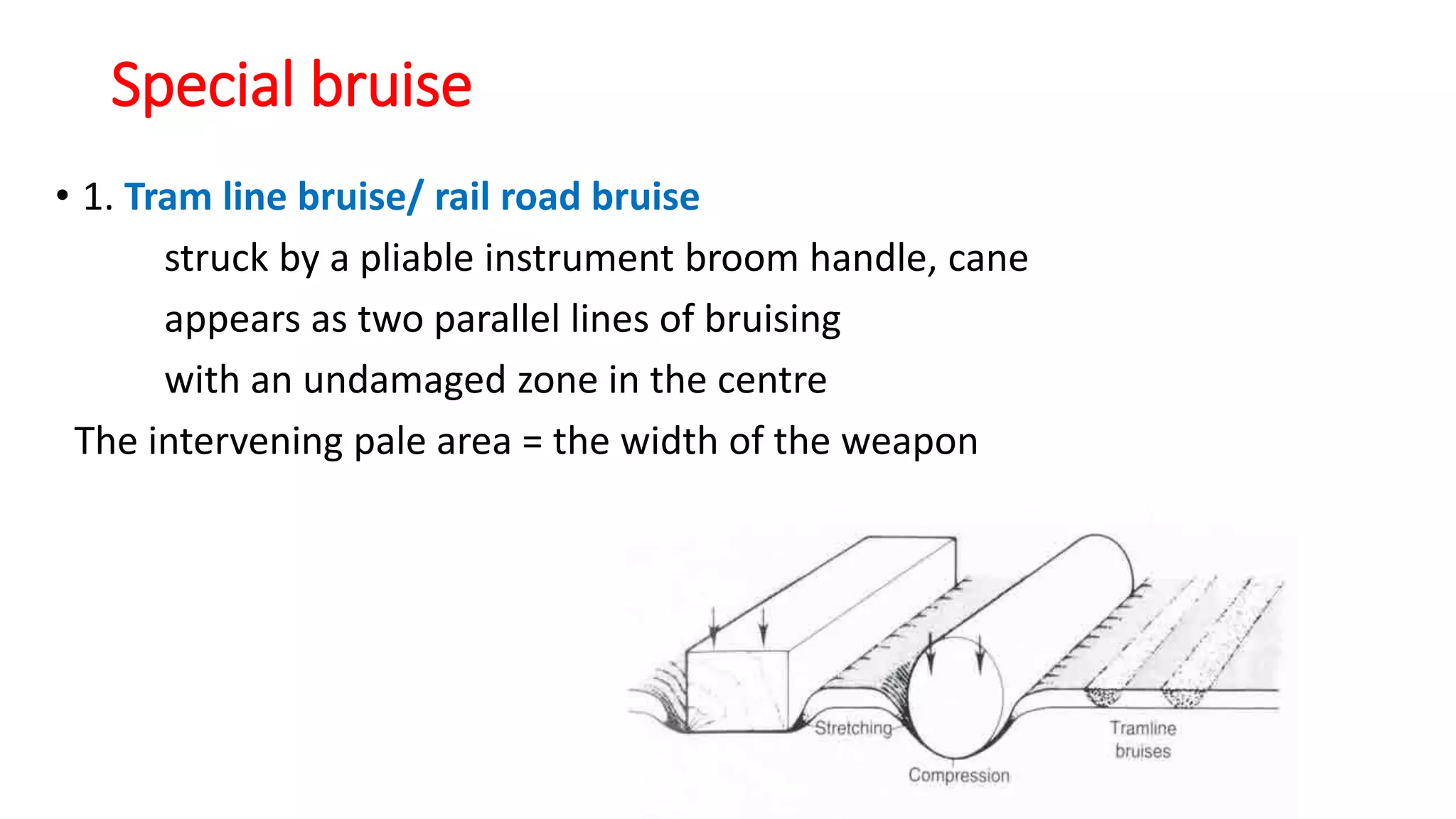 Special bruise
• 1. Tram line bruise/ rail road bruise
struck by a pliable instrument broom handle, cane
appears as two parallel lines of bruising
with an undamaged zone in the centre
The intervening pale area = the width of the weapon
 