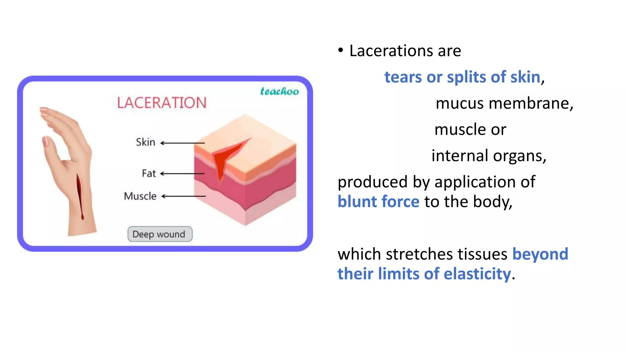 • Lacerations are
tears or splits of skin,
mucus membrane,
muscle or
internal organs,
produced by application of
blunt force to the body,
which stretches tissues beyond
their limits of elasticity.
 