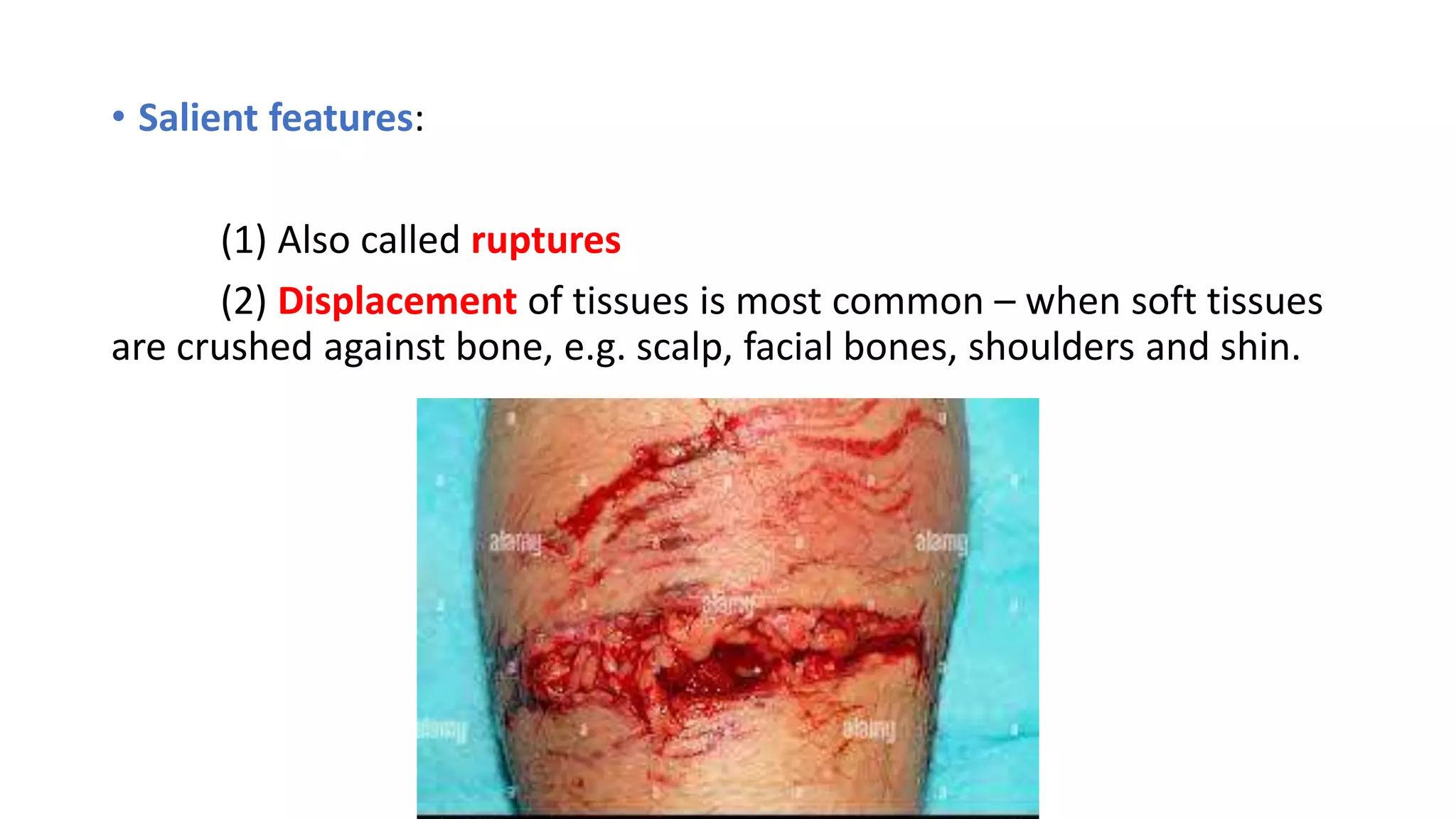 • Salient features:
(1) Also called ruptures
(2) Displacement of tissues is most common – when soft tissues
are crushed against bone, e.g. scalp, facial bones, shoulders and shin.
 