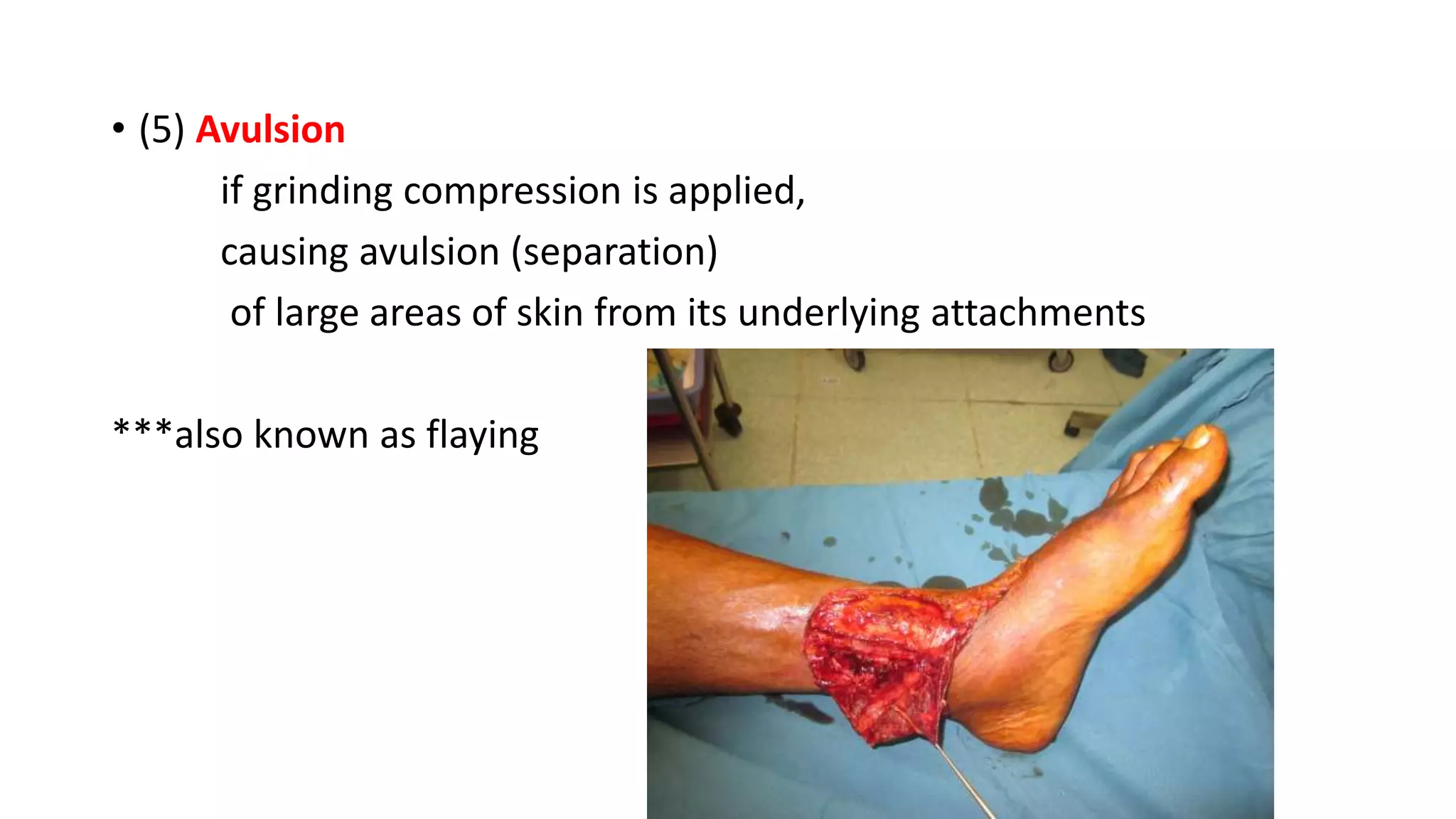 • (5) Avulsion
if grinding compression is applied,
causing avulsion (separation)
of large areas of skin from its underlying attachments
***also known as flaying
 