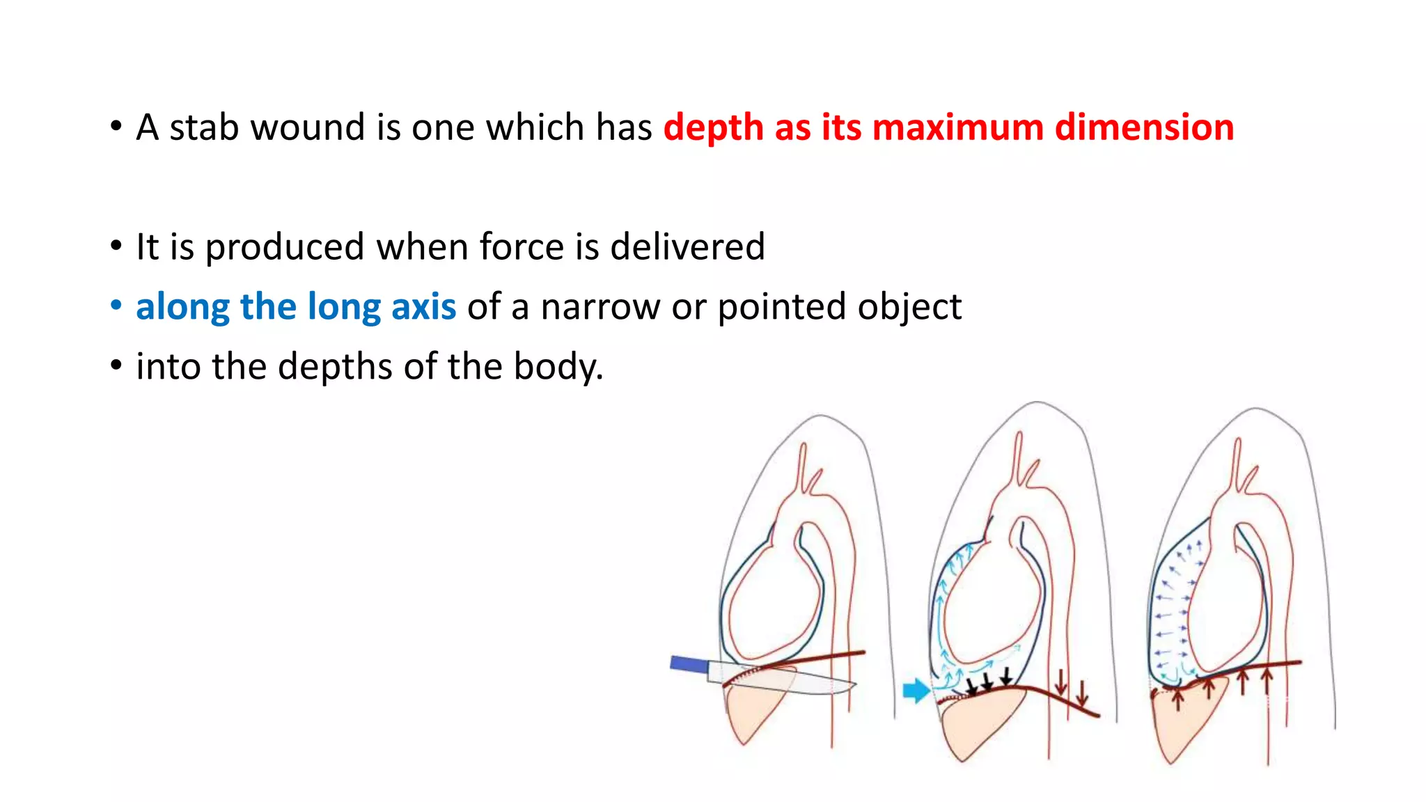 • A stab wound is one which has depth as its maximum dimension
• It is produced when force is delivered
• along the long axis of a narrow or pointed object
• into the depths of the body.
 