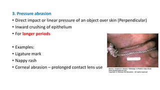 3. Pressure abrasion
• Direct impact or linear pressure of an object over skin (Perpendicular)
• Inward crushing of epithelium
• For longer periods
• Examples:
• Ligature mark
• Nappy rash
• Corneal abrasion – prolonged contact lens use
 