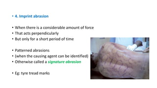 • 4. Imprint abrasion
• When there is a considerable amount of force
• That acts perpendicularly
• But only for a short period of time
• Patterned abrasions
• (when the causing agent can be identified)
• Otherwise called a signature abrasion
• Eg: tyre tread marks
 
