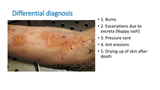 Differential diagnosis
• 1. Burns
• 2. Excoriations due to
excreta (Nappy rash)
• 3. Pressure sore
• 4. Ant erosions
• 5. Drying up of skin after
death
 