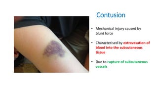 Contusion
• Mechanical injury caused by
blunt force
• Characterised by extravasation of
blood into the subcutaneous
tissue
• Due to rupture of subcutaneous
vessels
 