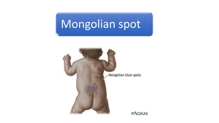 Mongolian spot
 