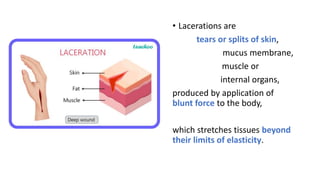 • Lacerations are
tears or splits of skin,
mucus membrane,
muscle or
internal organs,
produced by application of
blunt force to the body,
which stretches tissues beyond
their limits of elasticity.
 