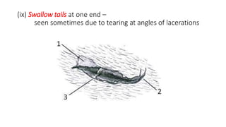 (ix) Swallow tails at one end –
seen sometimes due to tearing at angles of lacerations
 