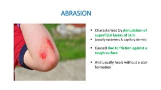 ABRASION
 Characterised by denudation of
superficial layers of skin
 (usually epidermis & papillary dermis)
 Caused due to friction against a
rough surface
 And usually heals without a scar
formation
 