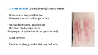 • 2. Graze abrasion (sliding/grinding/scrape abrasion)
• Horizontal or tangential friction
• Between skin and hard rough surface
• Uneven longitudinal parallel lines
• Direction can be appreciated
(heaping up of epithelium at the opposite end)
• Most common
• Particles of glass, gravel or dirt may be found
 