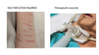 SELF-INFLICTED INJURIES Therapeutic wounds
 