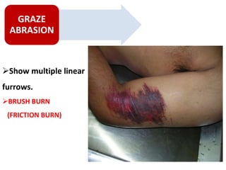Friction Burn Def Mechanical Injuries.pptx