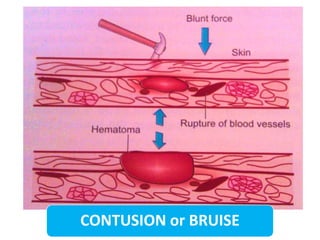 Mechanical Injuries.pptx