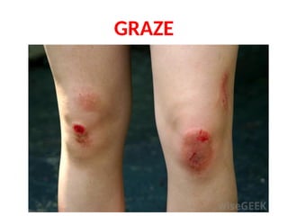 MECHANICAL INJURIES - ABRASION & CONTUSION.pptx