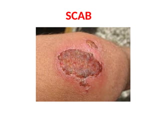 MECHANICAL INJURIES - ABRASION & CONTUSION.pptx