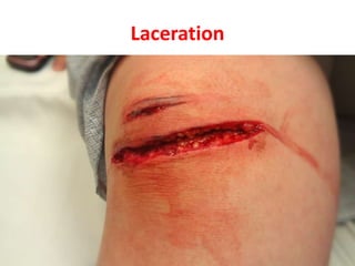 Laceration
 