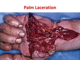 Palm Laceration
 