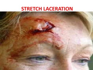 STRETCH LACERATION
 