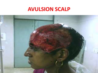 AVULSION SCALP
 