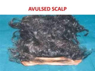 AVULSED SCALP
 