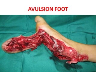 AVULSION FOOT
 