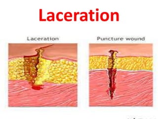 Laceration
 