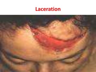 Laceration
 
