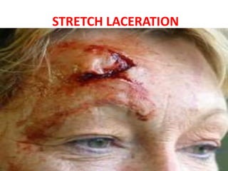 MECHANICAL INJURIES - LACERATIONS.pptx