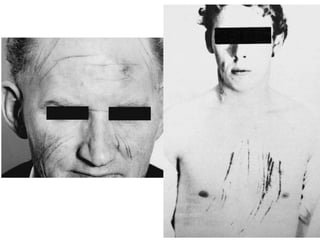 Sharp Force Trauma Radiograph Mechanical injuries(ICS) due to sharp force.ppt