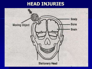 HEAD INJURIES
 