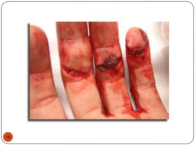 mechanical injury 3 mechanical injury