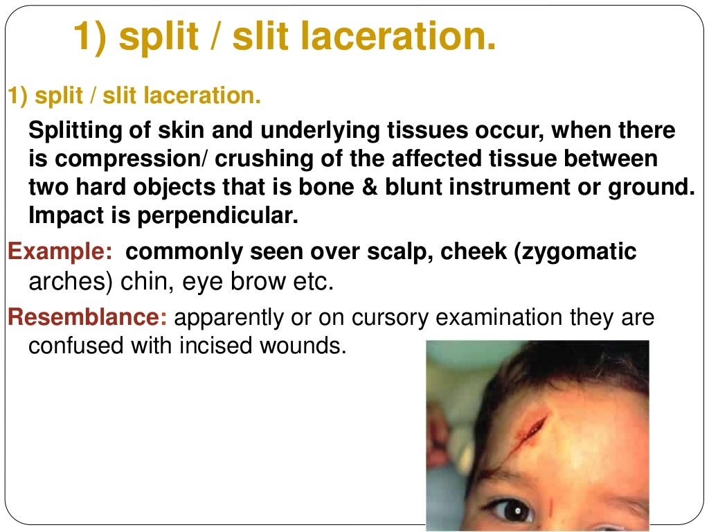 mechanical injury 3 mechanical injury