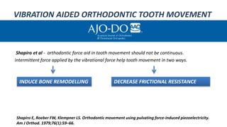 VIBRATION AIDED ORTHODONTIC TOOTH MOVEMENT
Shapiro et al - orthodontic force aid in tooth movement should not be continuou...