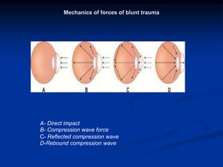 Mechanical ocular trauma pptx