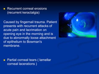  Recurrent corneal erosions
(recurrent keractalgia)
Caused by fingernail trauma. Patient
presents with recurrent attacks of
acute pain and lacrimation on
opening eye in the morning and is
due to abnormally loose attachment
of epithelium to Bowman's
membrane.
 Partial corneal tears ( lamellar
corneal lacerations )
 
