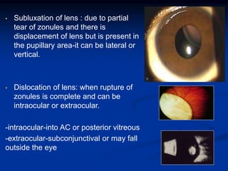 • Subluxation of lens : due to partial
tear of zonules and there is
displacement of lens but is present in
the pupillary area-it can be lateral or
vertical.
• Dislocation of lens: when rupture of
zonules is complete and can be
intraocular or extraocular.
-intraocular-into AC or posterior vitreous
-extraocular-subconjunctival or may fall
outside the eye
 