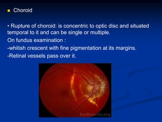  Choroid
• Rupture of choroid: is concentric to optic disc and situated
temporal to it and can be single or multiple.
On fundus examination :
-whitish crescent with fine pigmentation at its margins.
-Retinal vessels pass over it.
 
