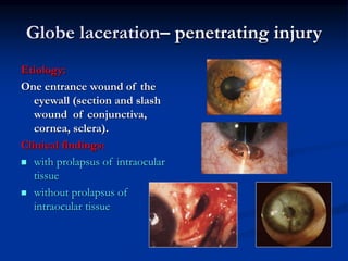 Globe laceration– penetrating injury
Etiology:
One entrance wound of the
eyewall (section and slash
wound of conjunctiva,
cornea, sclera).
Clinical findings:
 with prolapsus of intraocular
tissue
 without prolapsus of
intraocular tissue
 