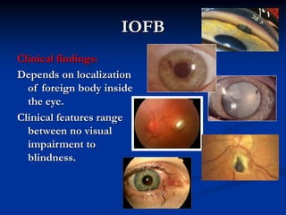 IOFB
Clinical findings:
Depends on localization
of foreign body inside
the eye.
Clinical features range
between no visual
impairment to
blindness.
 