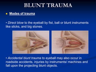 BLUNT TRAUMA
 Modes of trauma
• Direct blow to the eyeball by fist, ball or blunt instruments
like sticks, and big stones.
• Accidental blunt trauma to eyeball may also occur in
roadside accidents, injuries by instruments/ machines and
fall upon the projecting blunt objects.
 