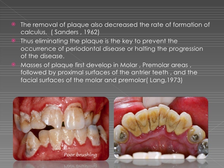 Mechanical plaque control
