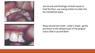 Mechanical plaque control | PPTX