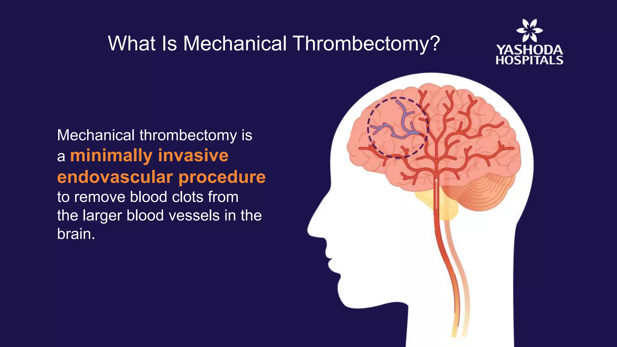 Mechanical Thrombectomy for Acute Ischemic Stroke | Brain Stroke ...